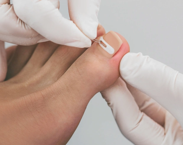Permanent Relief from Painful Ingrown Toenails