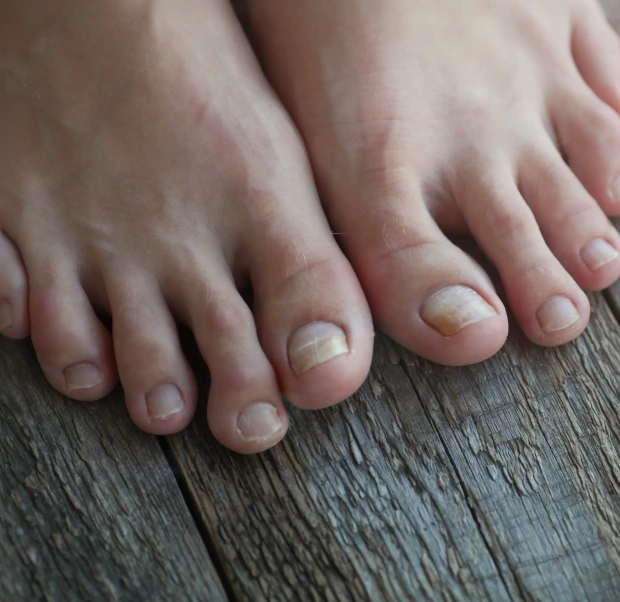 Relief for Common Foot Nail & Skin Conditions